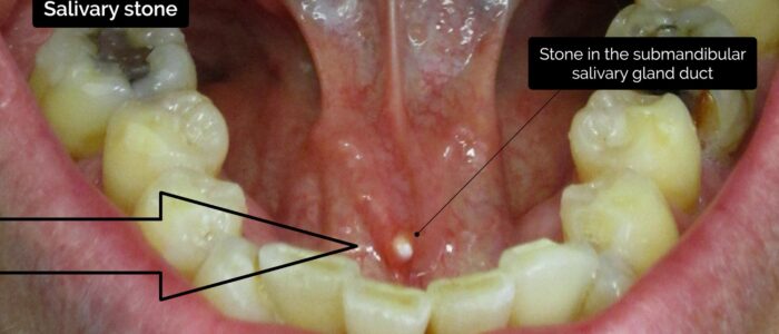 Oral cavity exam - Salivary stone in submandibular salivary duct