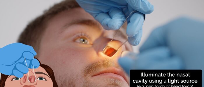 Nasal examination - inserting a thudicum