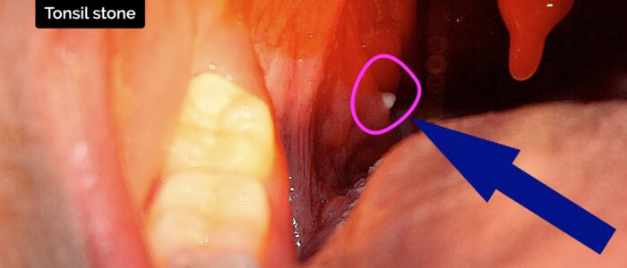 Oral cavity exam - Tonsil stone
