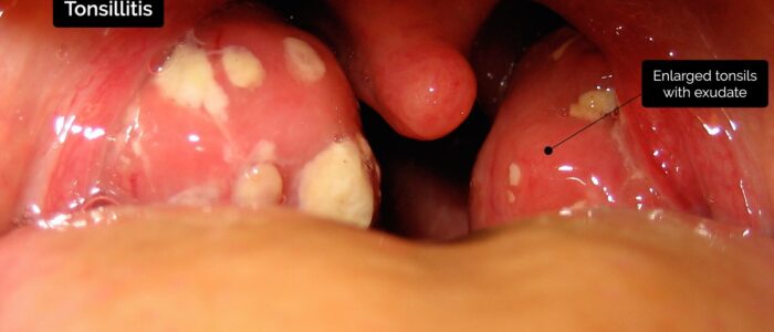 Oral cavity exam - Tonsillitis