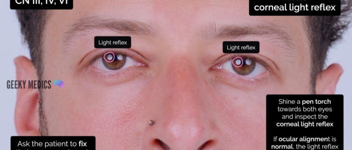 Cranial nerve exam - Inspect the corneal light reflex on each eye