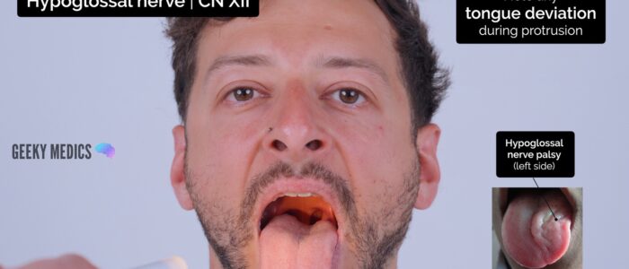 Cranial nerve exam - Inspect protruded tongue