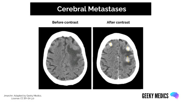 CT head interpretation - Cerebral metastases