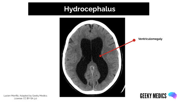 CT head interpretation - Hydrocephalus