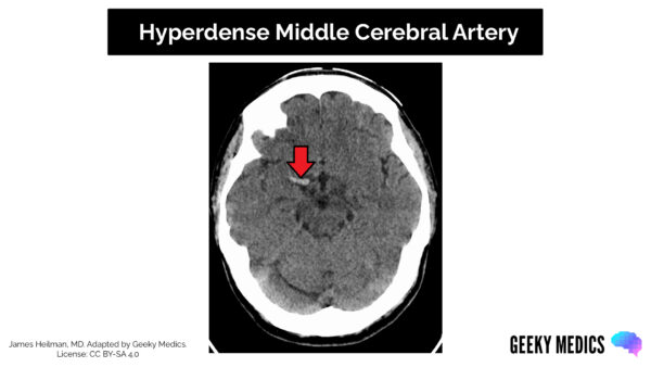 CT head interpretation - Hyperdense Middle Cerebral Artery