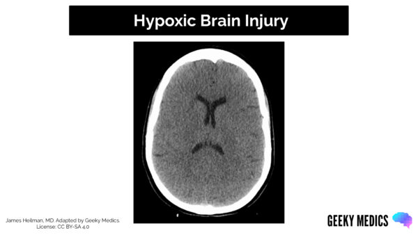CT head interpretation - Hypoxic Brain Injury