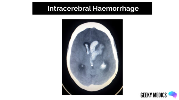 CT head interpretation - Intracerebral Haemorrhage