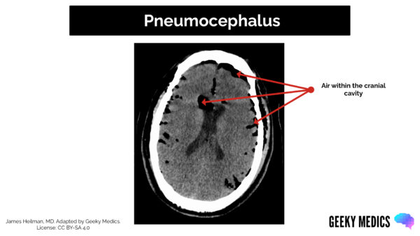CT head interpretation - Pneumocephalus