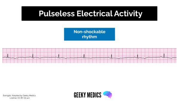 Pulseless electrical activity