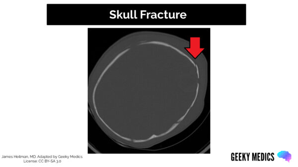 CT head interpretation - Skull fracture