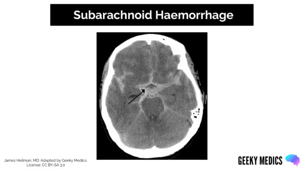 CT Head Interpretation - Subarachnoid haemorrhage