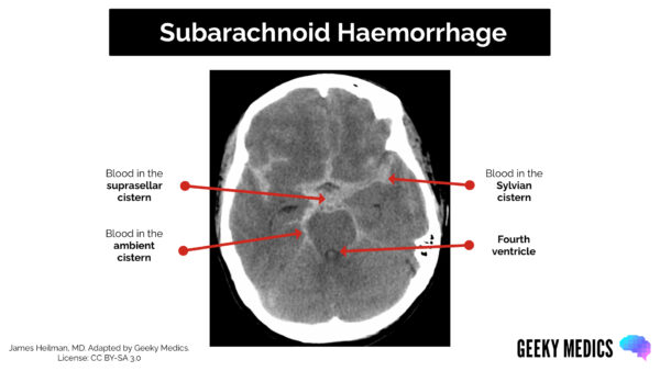 CT head interpretation - Subarachnoid haemorrhage cisterns