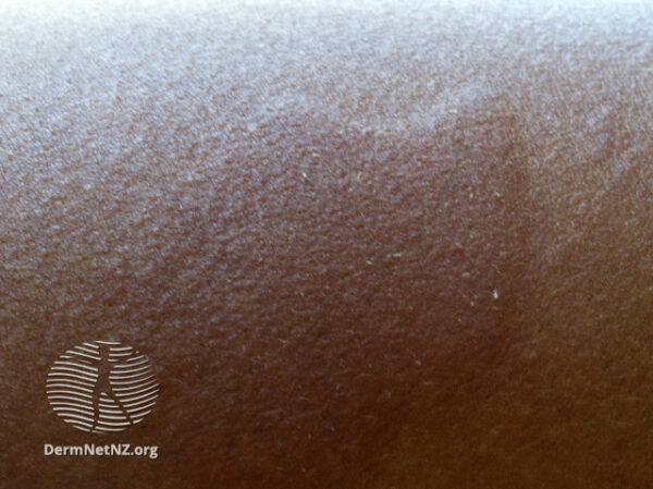 Uritcarial lesion on dark skin