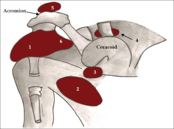 Diagram of normal bursae surrounding the shoulder joint: (1) subacromial-subdeltoid bursa, (2) subscapular recess, (3) subcoracoid bursa, (4) coracoclavicular bursa, (5) supra-acromial bursa and (6) medial extension of subacromial-subdeltoid bursa