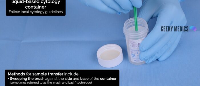 Immediately transfer the sample to a cytology container