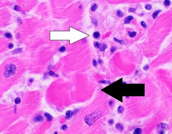 his histological specimen shows lymphocytic myocarditis. The white arrow is pointing to lymphocytes and the black arrow is pointing to a necrosed myocyte.