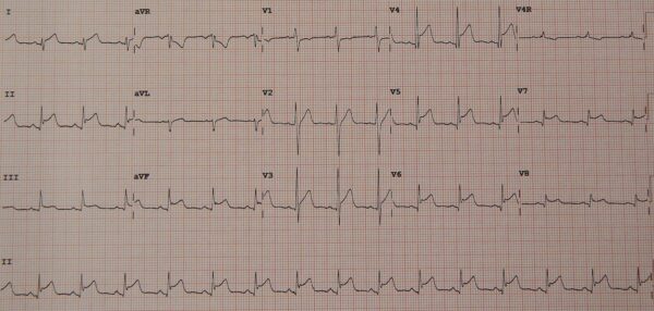 An ECG showing diffuse ST elevation due to myopericarditis