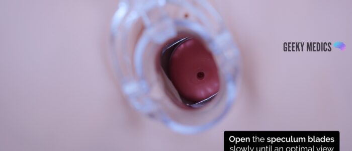 Open the speculum blades gently to obtain an optimal view of the cervix