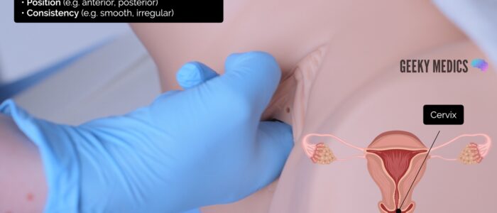 Bimanual exam - Palpate the cervix