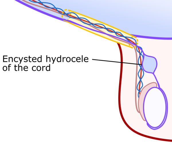 Coronal view of the right testes showing a collection of fluid within an otherwise obliterated processus vaginalis is seen, termed an encysted hydrocele of the cord