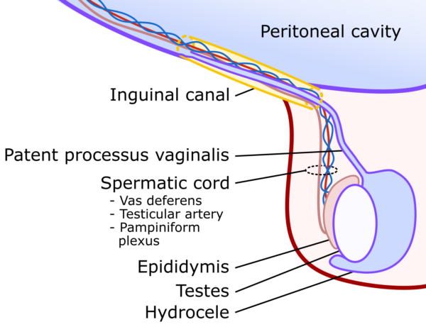 Coronal view of a normal right testes with an obliterated processus vaginalis and a small amount of physiological fluid between the visceral and parietal tunica vaginalis.