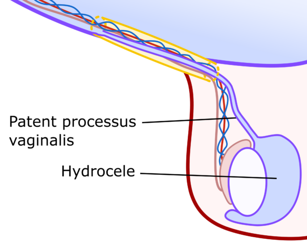 Coronal view of the right testes showing a patent processus vaginalis connecting to a communicating hydrocele.