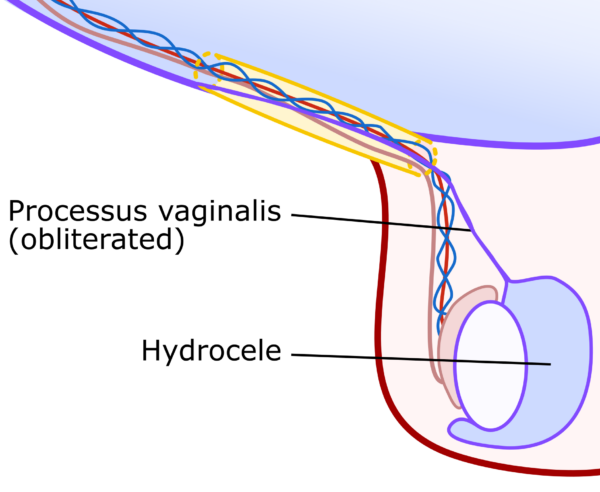 Coronal view of the right testes showing a non-communicating hydrocele.