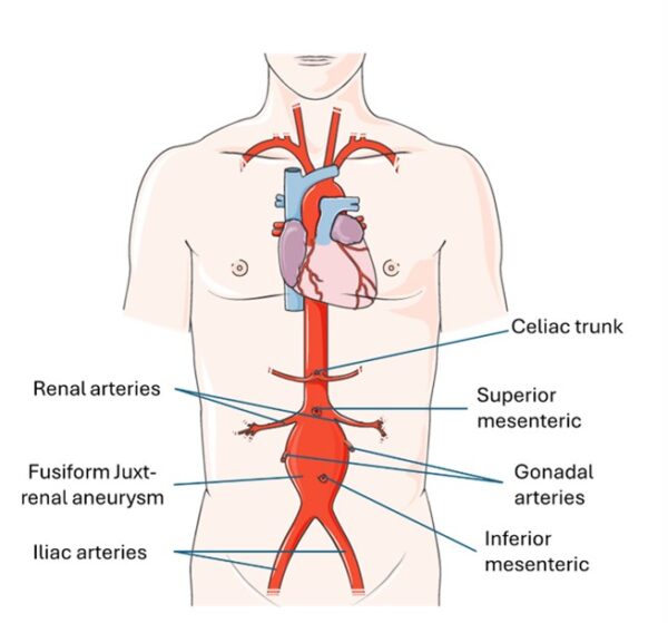 Clinical anatomy of AAA