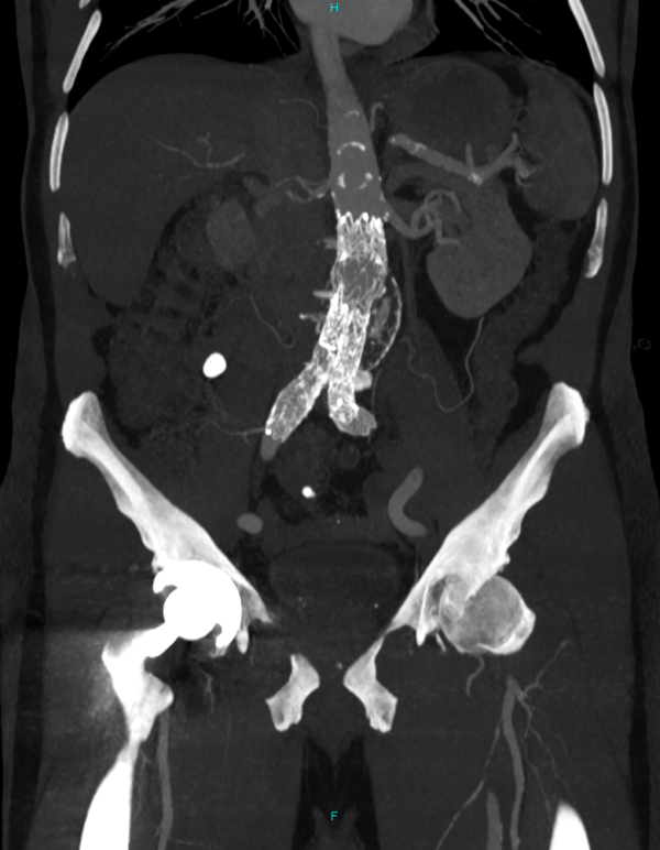 CT showing an EVAR using a Gore graft (Infrarenal fixation)