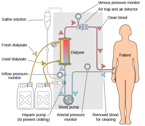 A simplified diagram of a haemodialysis