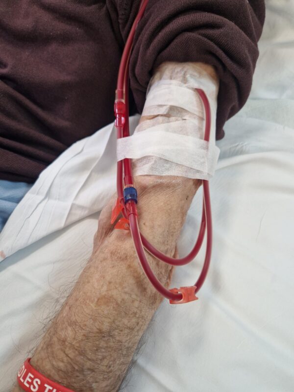 A fistula being used for haemodialysis