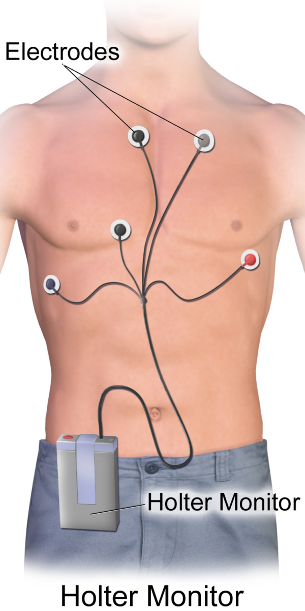 An illustration depicting a Holter monitor