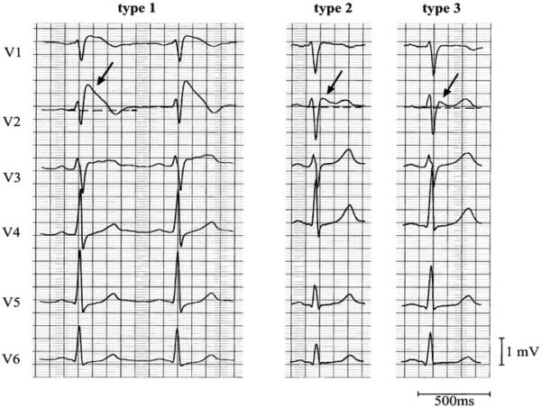 Types of Brugada Syndrome
