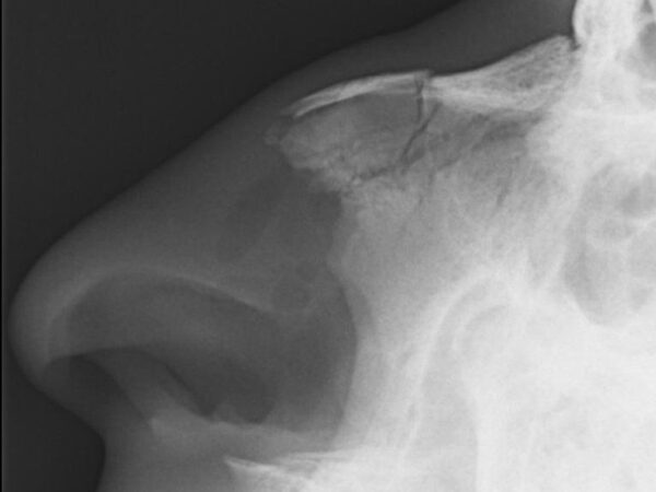 Figure 3: X-ray nasal bone fracture.